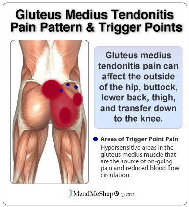 What kind of doctor do I need to see for tendinitis in the hips?