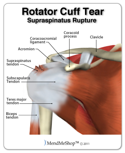 Torn supraspinatus tendon of the rotator cuff.