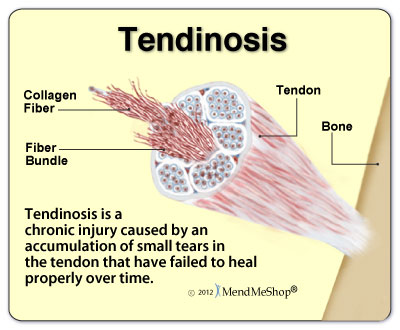 Risk of tendon rupture after steroid injection