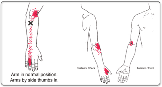 Tennis Elbow pain patterns